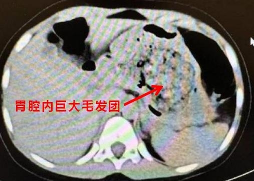浙江一5岁女孩确诊长发公主综合征：胃里一大团头发 医生都懵了 ！